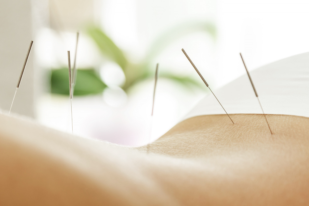 female back with steel needles during procedure acupuncture therapy